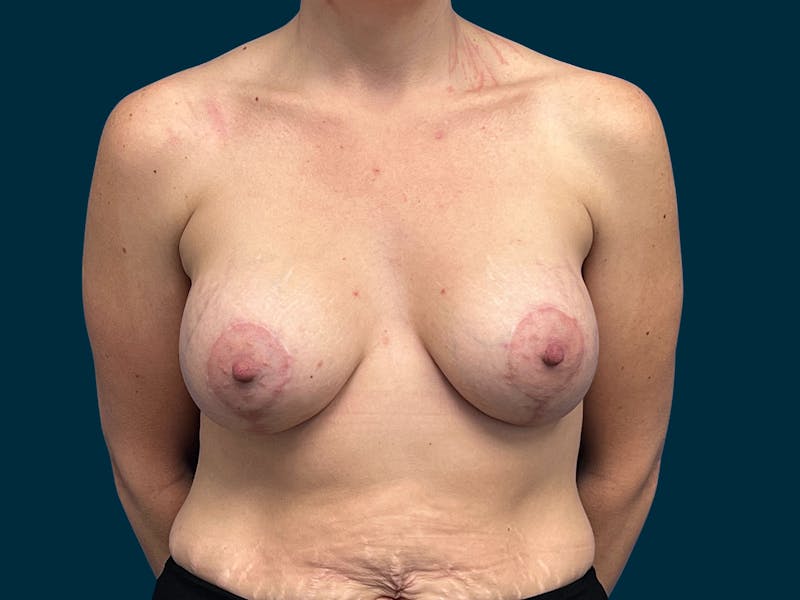Breast Lift Before & After Gallery - Patient 377666 - Image 2