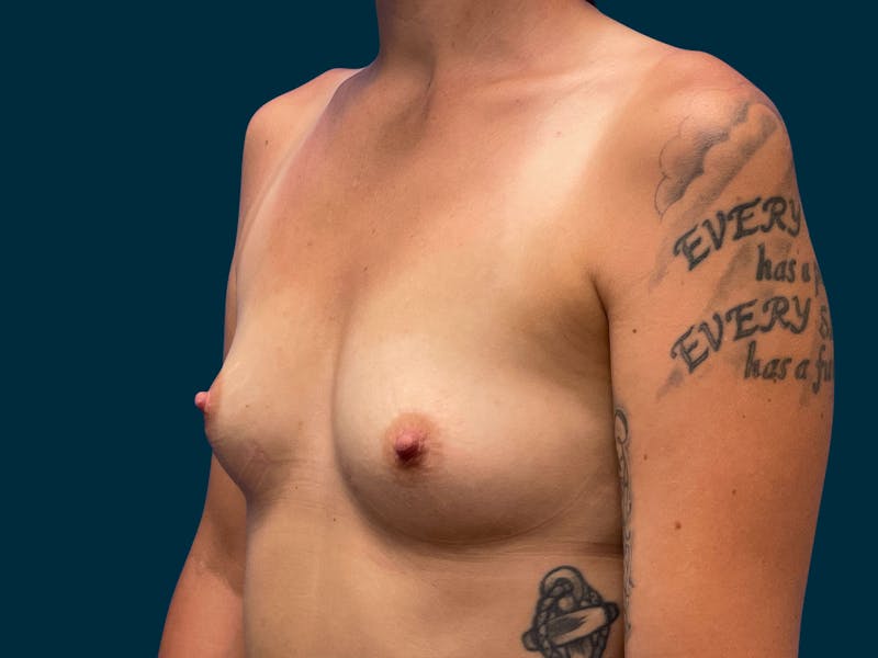 Breast Augmentation Before & After Gallery - Patient 264396 - Image 9