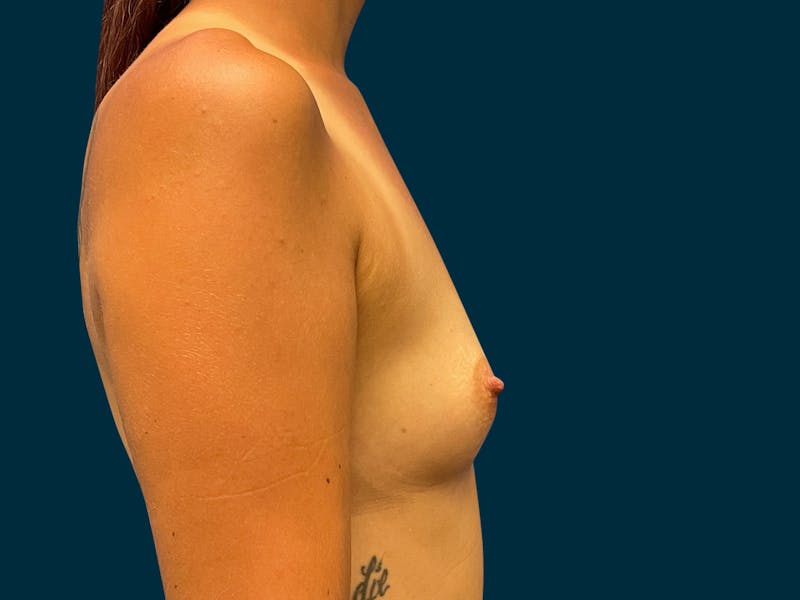Breast Augmentation Before & After Gallery - Patient 264396 - Image 7