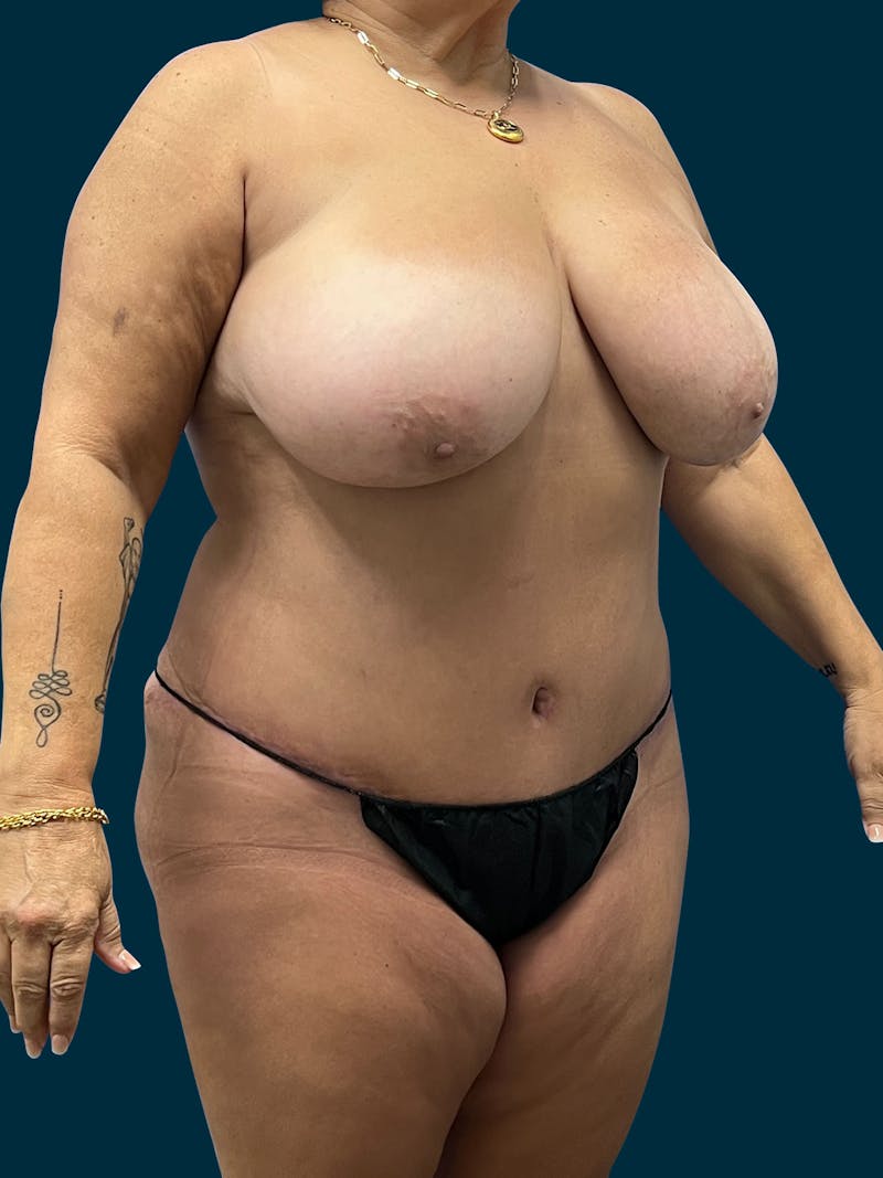 Abdominoplasty Before & After Gallery - Patient 355373 - Image 6