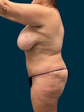 Liposuction Before & After Gallery - Patient 355504 - Image 4