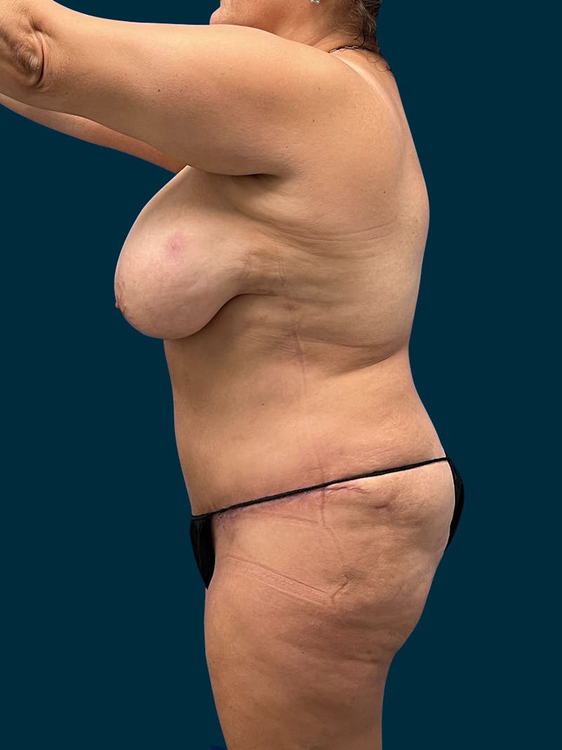 Abdominoplasty Before & After Gallery - Patient 355373 - Image 4