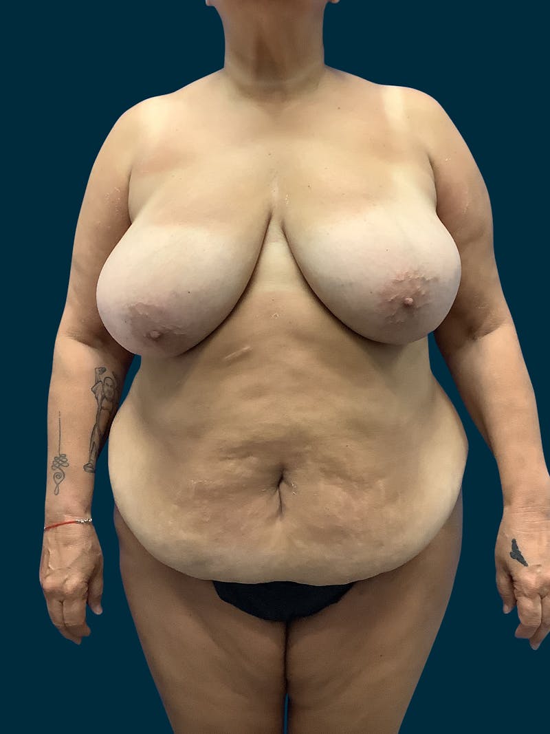 Patient iEP95uwoRhqUbZOJZd_-ZA - Tummy Tuck Before & After Photos