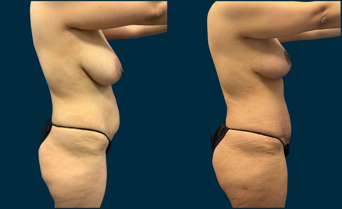 Abdominoplasty Before & After Gallery - Patient 378469 - Image 3