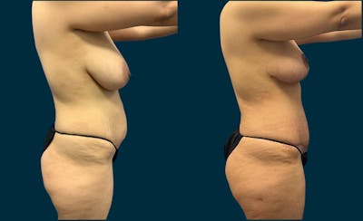 Breast Lift Before & After Gallery - Patient 385483 - Image 1