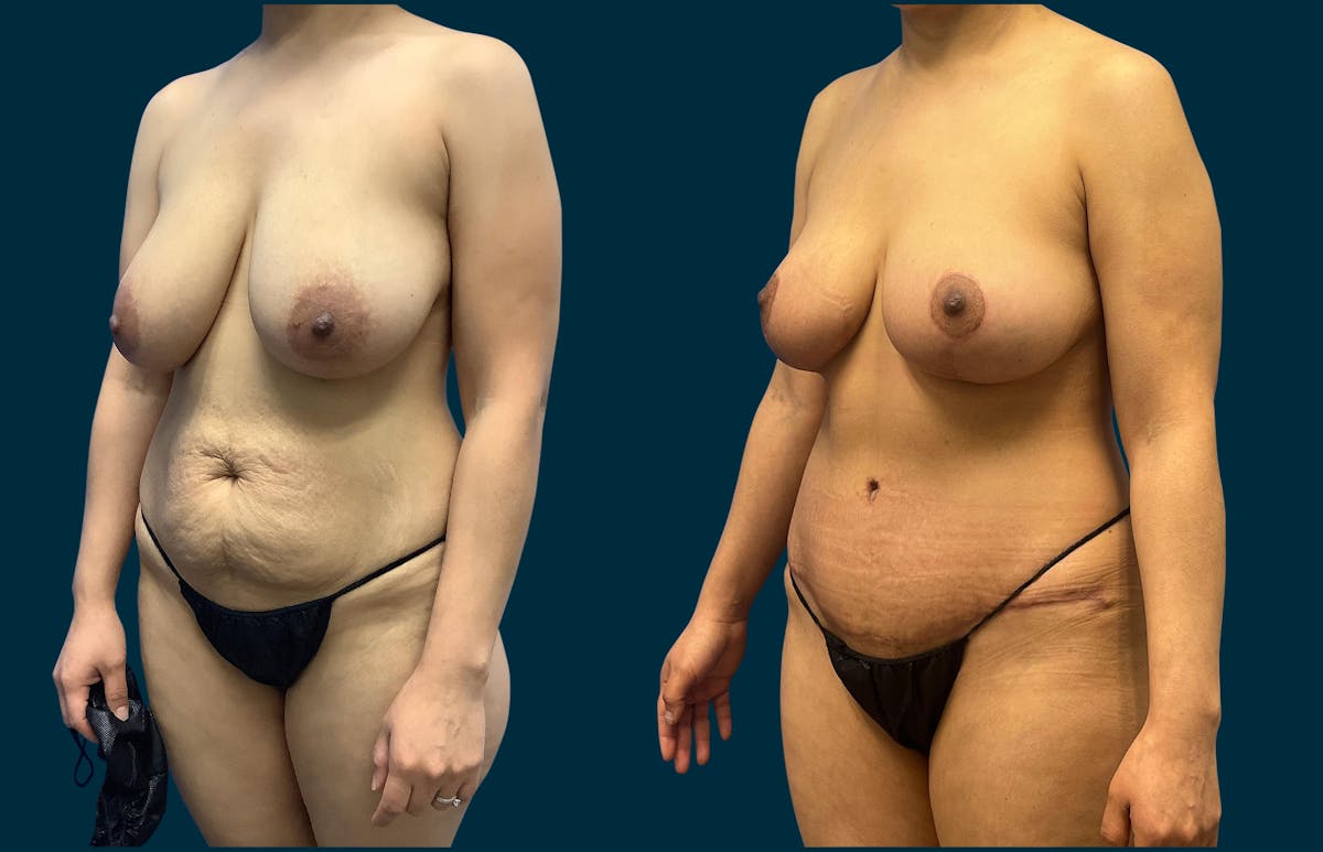 Breast Reduction Before & After Gallery - Patient 303402 - Image 3