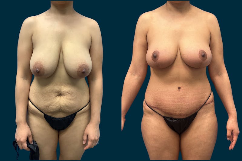 Patient AssnXnjnReKrgBaGxHFzCA - Breast Reduction Before & After Photos