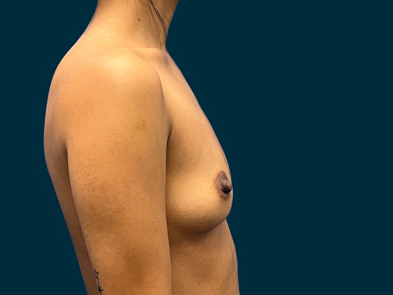 Breast Augmentation Before & After Gallery - Patient 375403 - Image 3
