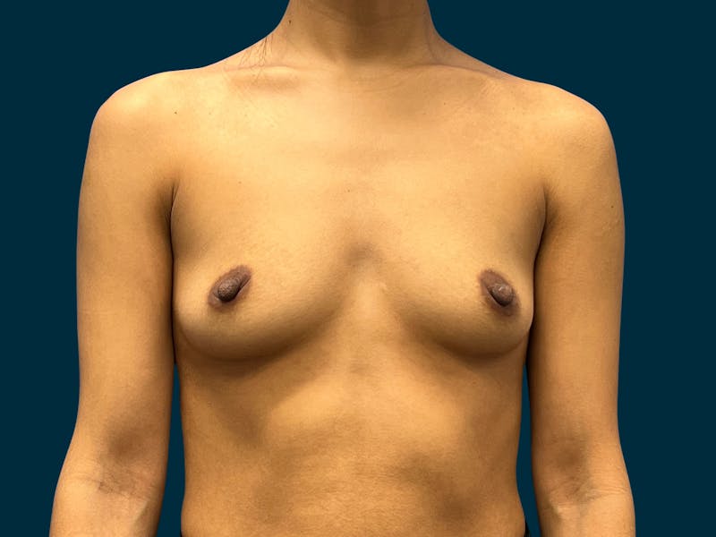 Breast Augmentation Before & After Gallery - Patient 375403 - Image 1