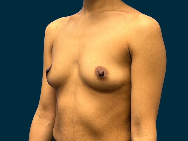 Breast Augmentation Before & After Gallery - Patient 375403 - Image 7