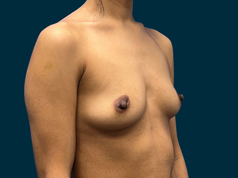 Breast Augmentation Before & After Gallery - Patient 375403 - Image 9