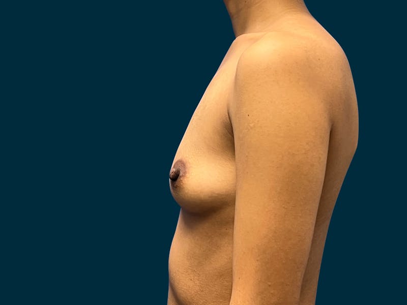 Breast Augmentation Before & After Gallery - Patient 375403 - Image 5