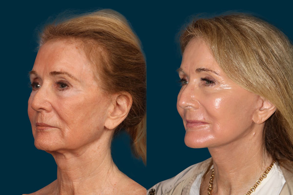 Facelift Before & After Gallery - Patient 169285 - Image 2