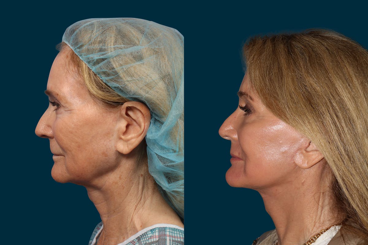 Neck Lift Before & After Gallery - Patient 478003 - Image 2