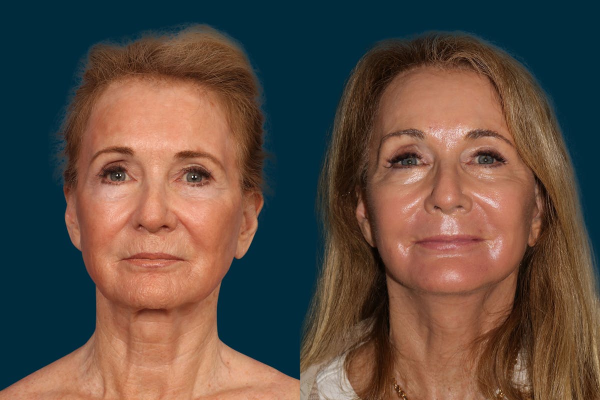 Neck Lift Before & After Gallery - Patient 478003 - Image 3
