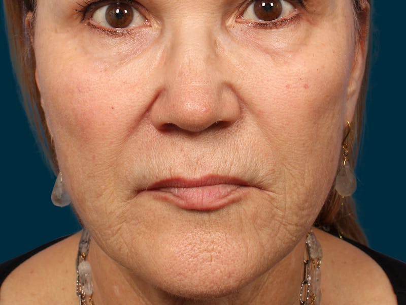 Lip Lift Before & After Gallery - Patient 328370 - Image 1