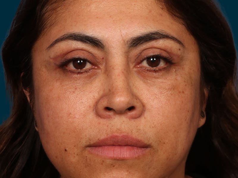 Facial Fat Transfer Before & After Gallery - Patient 204600 - Image 2