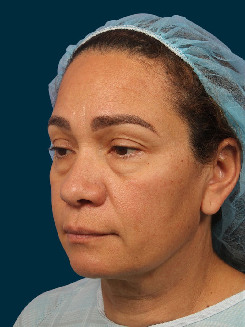 Facial Fat Transfer Before & After Gallery - Patient 381141 - Image 3