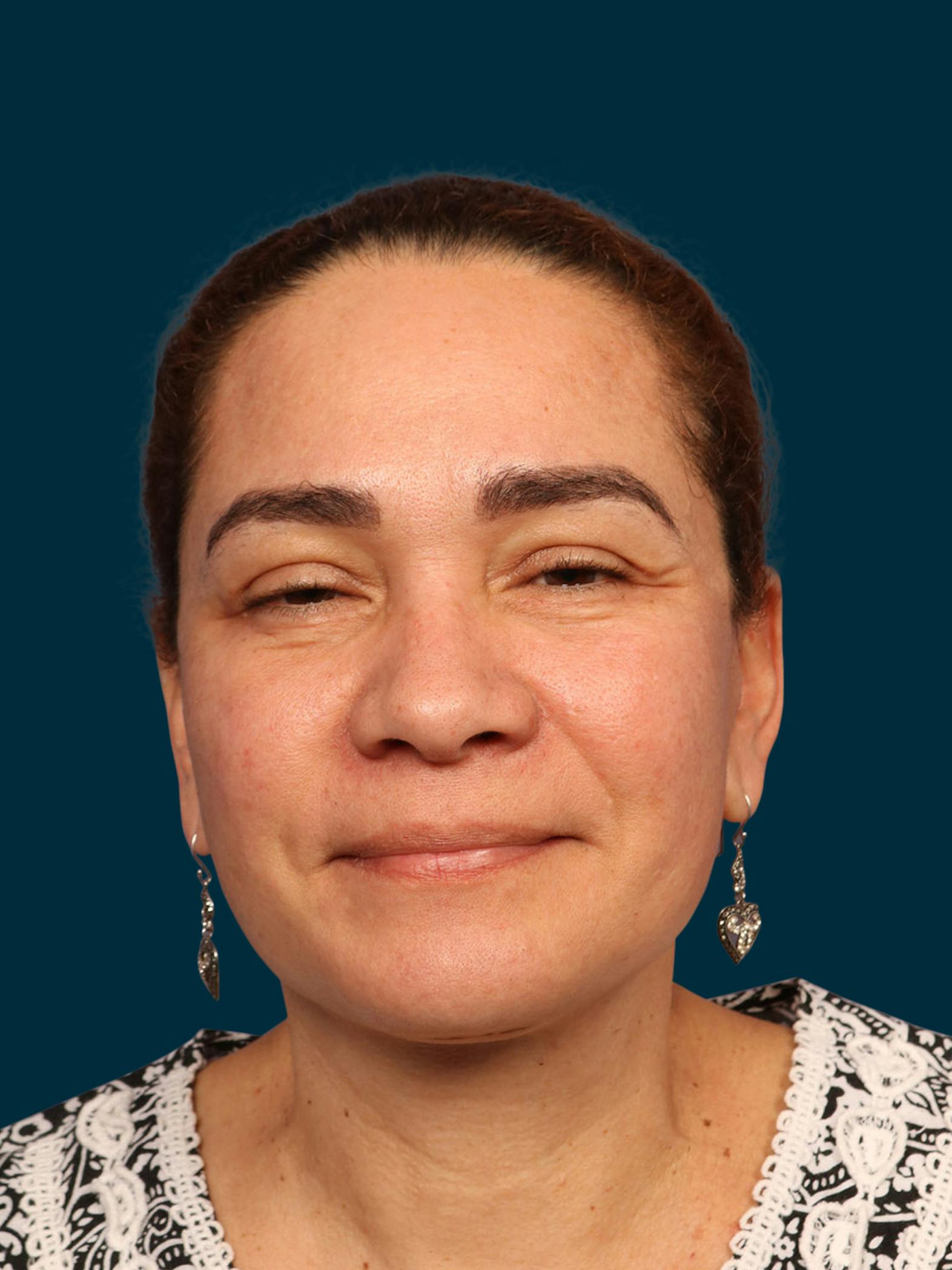 Body lift patient after media