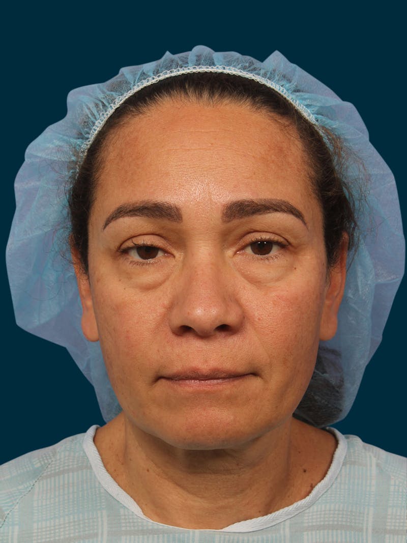 Neck Lift Before & After Gallery - Patient 833482 - Image 3