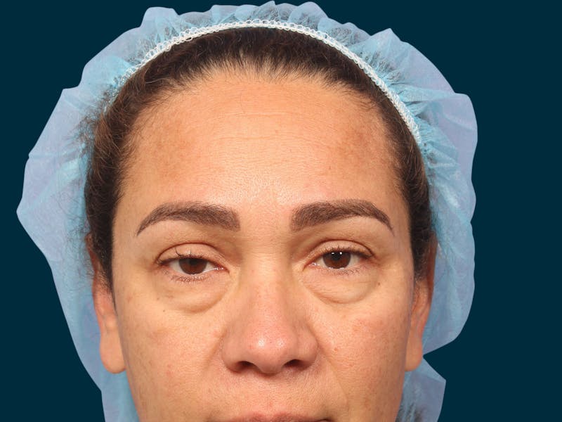 Facial Fat Transfer Before & After Gallery - Patient 381141 - Image 5