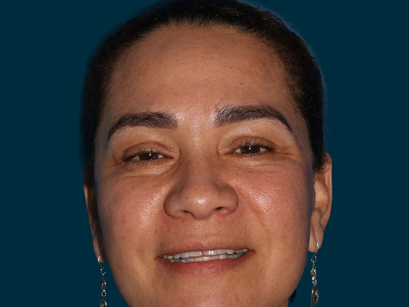 Blepharoplasty Before & After Gallery - Patient 304442 - Image 6