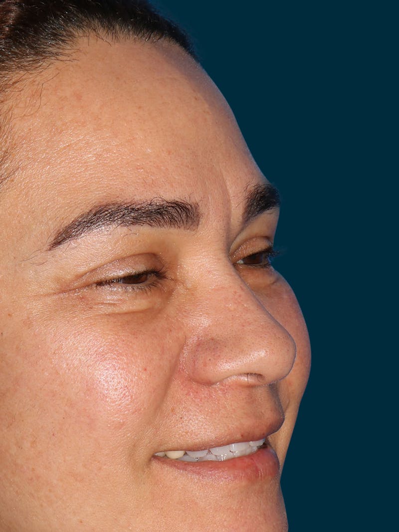 Blepharoplasty Before & After Gallery - Patient 304442 - Image 8