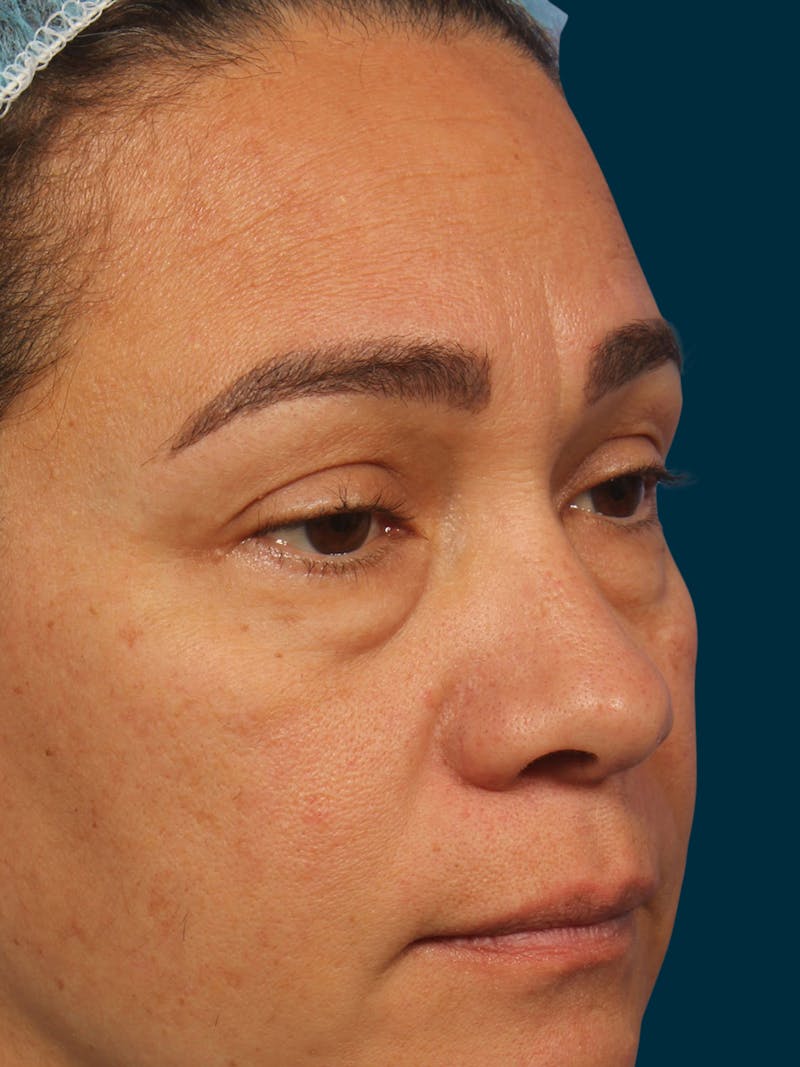 Facial Fat Transfer Before & After Gallery - Patient 381141 - Image 7