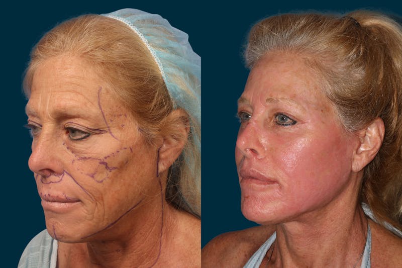 Patient Fd4peJRNQSWktLQSeWCbhA - Facelift Before & After Photos