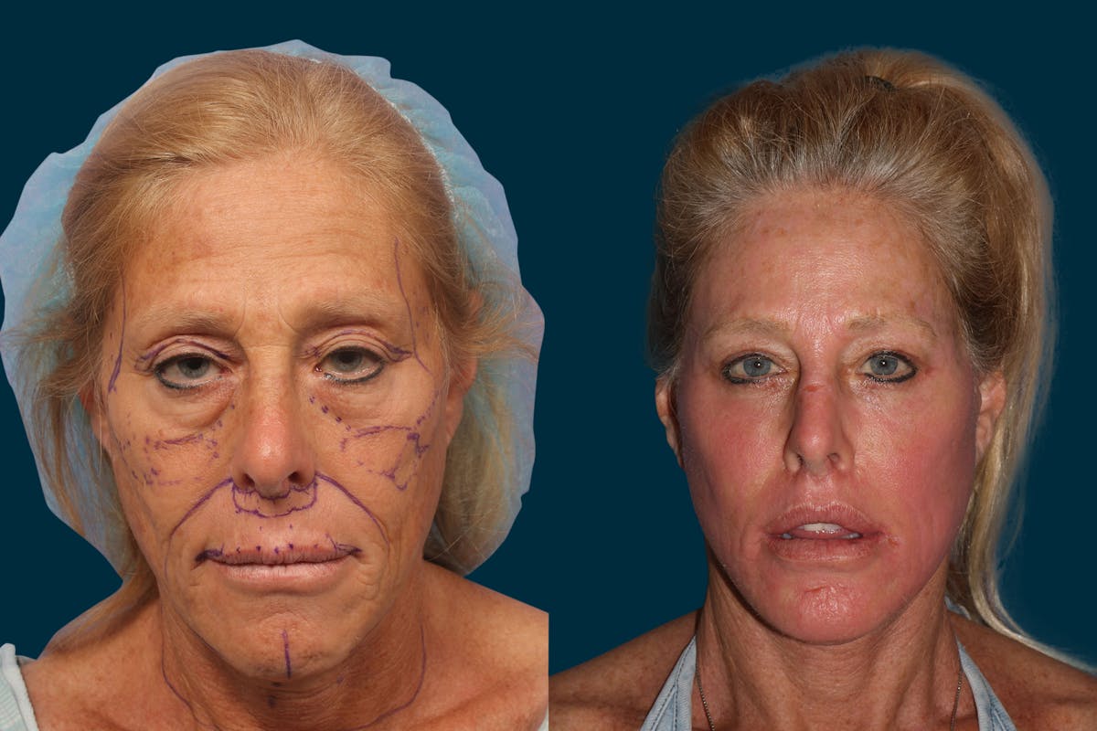 Facelift Before & After Gallery - Patient 182173 - Image 2