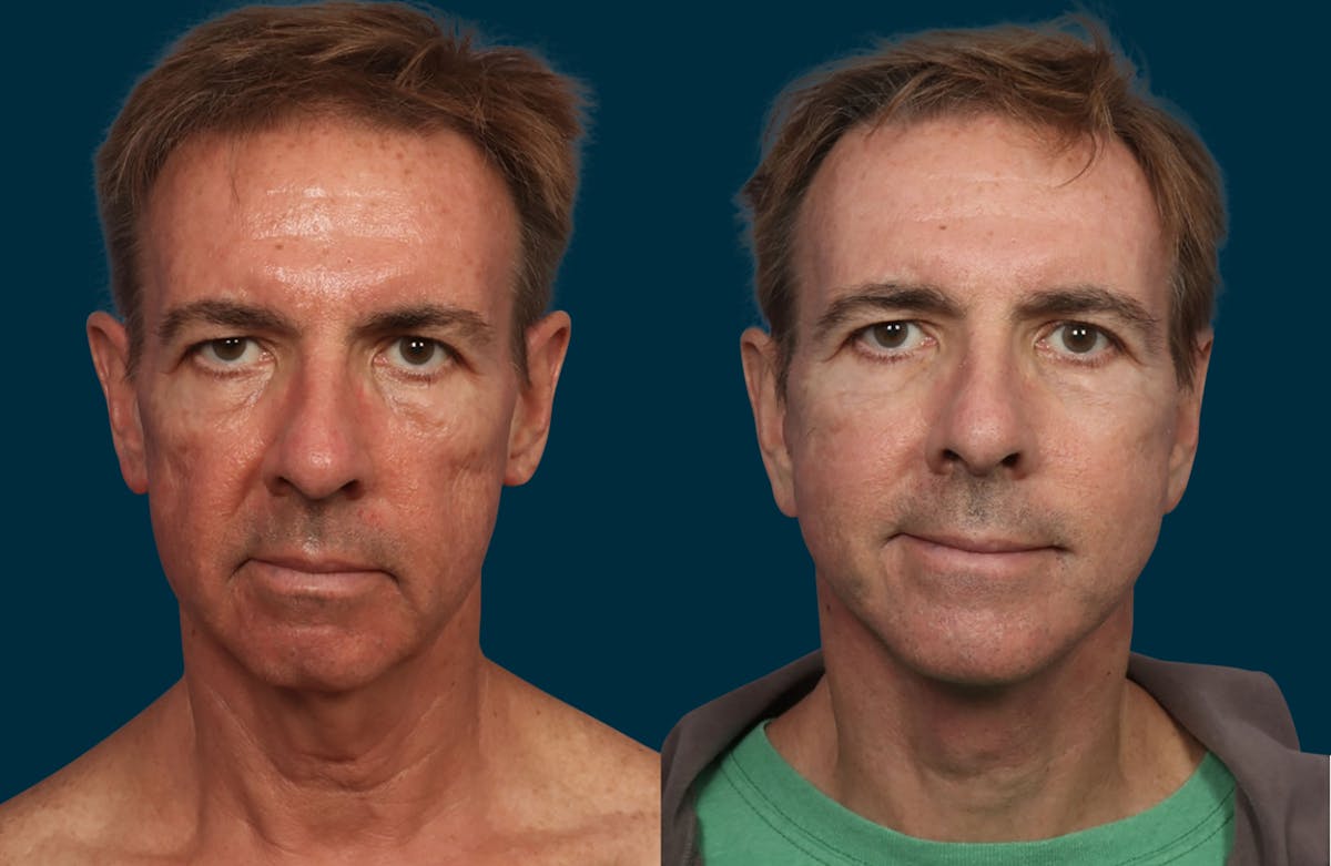Blepharoplasty Before & After Gallery - Patient 338531 - Image 1