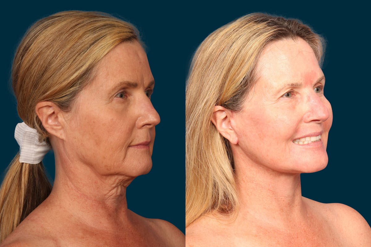 Neck Lift Before & After Gallery - Patient 693426 - Image 1