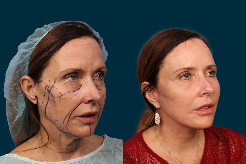 Patient X7ofvqtmRz6YsE1Ci3EDyQ - Neck Lift Before & After Photos