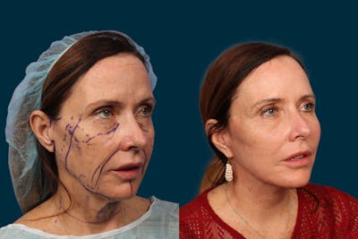 Neck Lift Before & After Gallery - Patient 148252 - Image 1