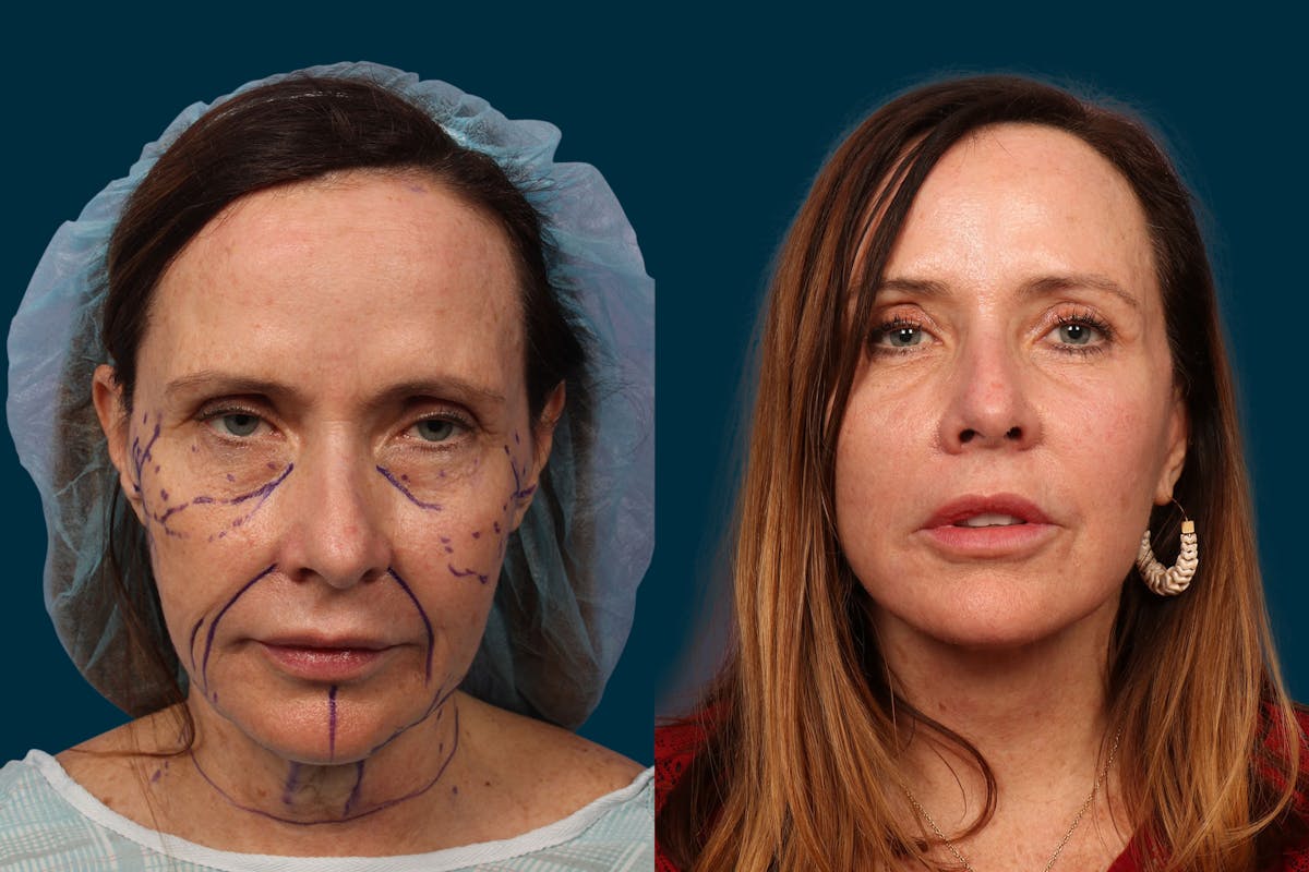 Neck Lift Before & After Gallery - Patient 148252 - Image 2