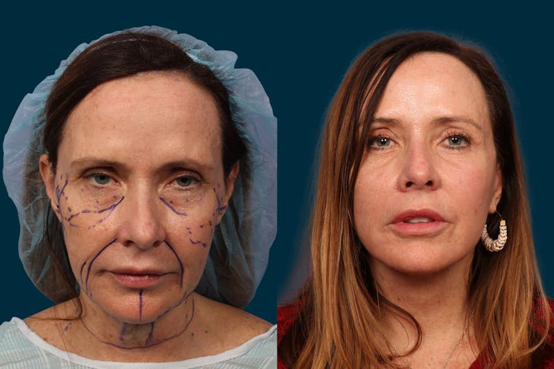 Patient b39r6LEsTSq7VA62E5RMHA - Blepharoplasty Before & After Photos
