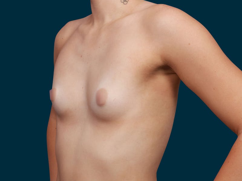 Breast Augmentation Before & After Gallery - Patient 257721 - Image 3