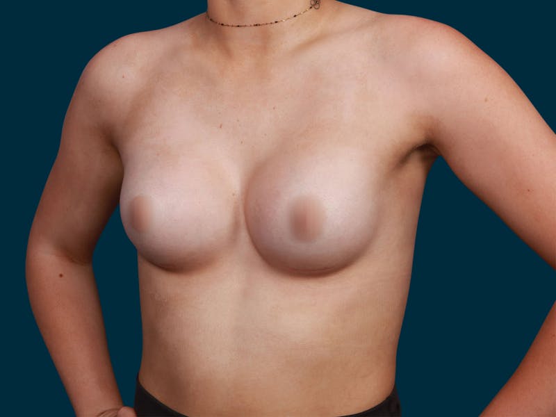 Breast Augmentation Before & After Gallery - Patient 257721 - Image 4