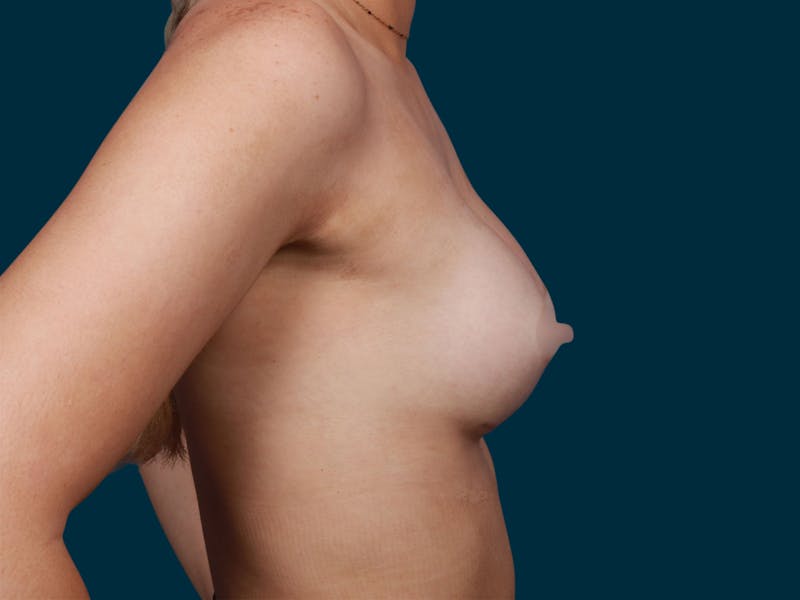Breast Augmentation Before & After Gallery - Patient 257721 - Image 6