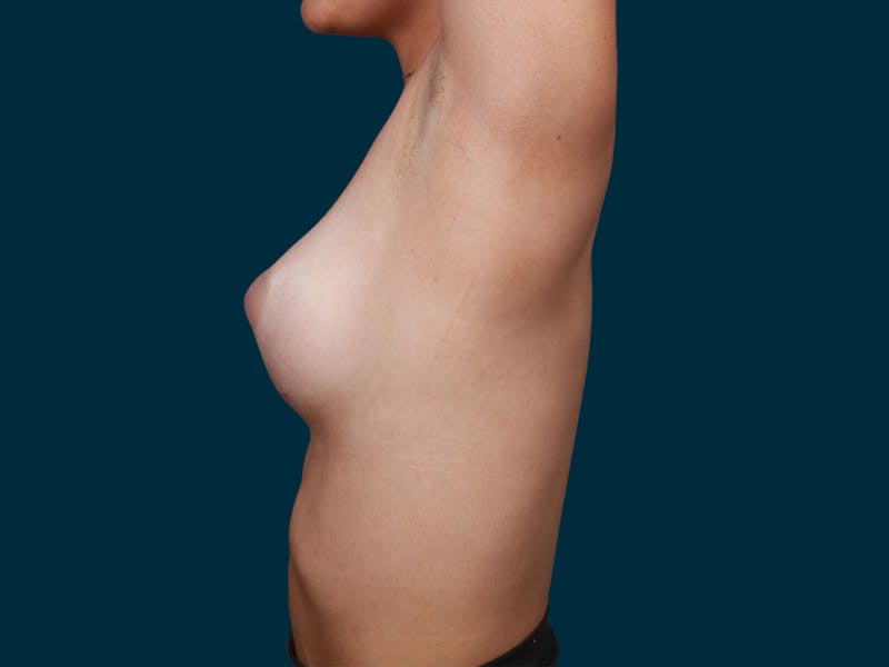 Breast Augmentation Before & After Gallery - Patient 257721 - Image 8