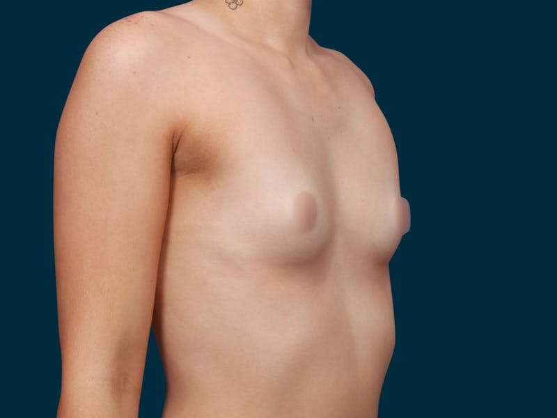 Breast Augmentation Before & After Gallery - Patient 257721 - Image 9