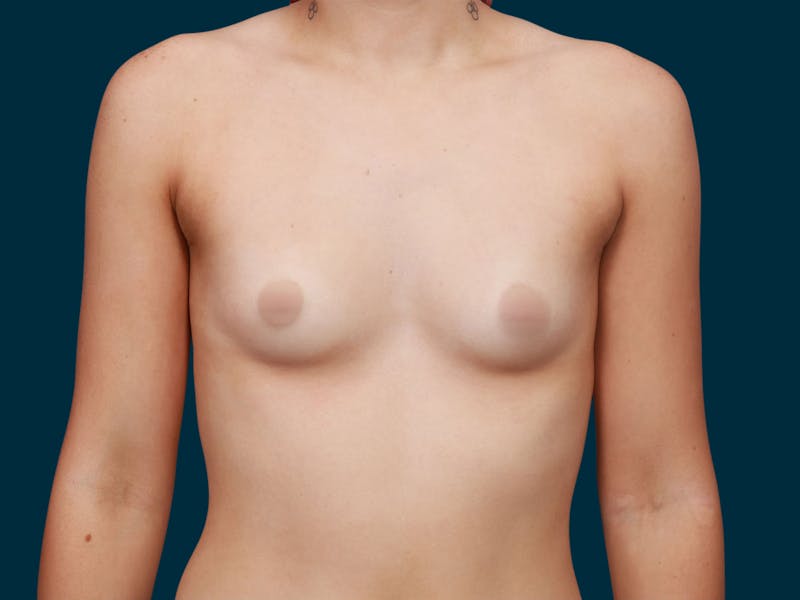 Breast Augmentation Before & After Gallery - Patient 257721 - Image 1