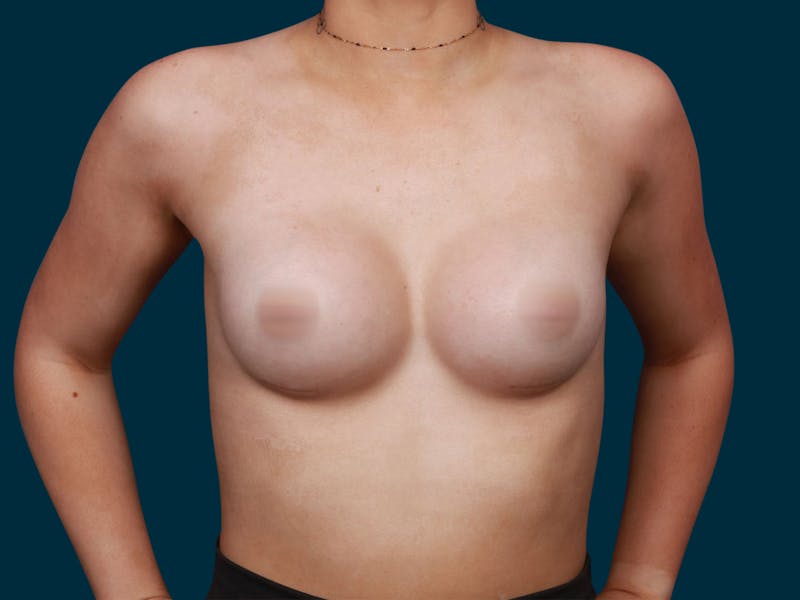 Breast Augmentation Before & After Gallery - Patient 257721 - Image 2