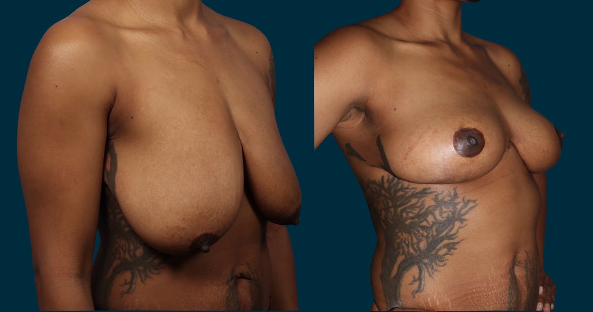 Breast Lift Before & After Gallery - Patient 179587 - Image 2