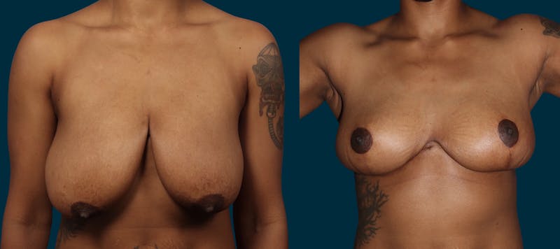 Breast Lift Before & After Gallery - Patient 179587 - Image 1