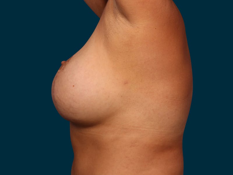 Breast Lift Before & After Gallery - Patient 177484 - Image 5