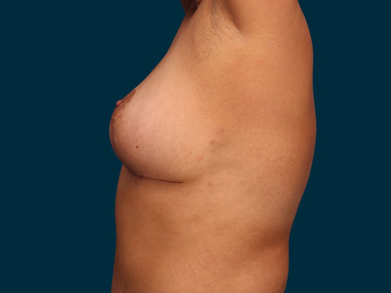 Breast Lift Before & After Gallery - Patient 177484 - Image 6