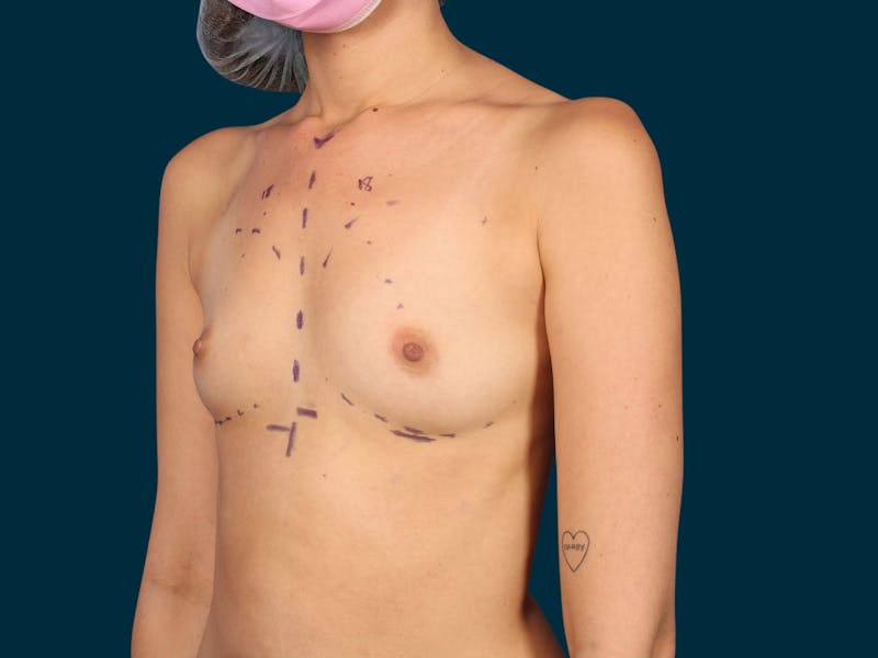 Breast Augmentation Before & After Gallery - Patient 134618 - Image 3