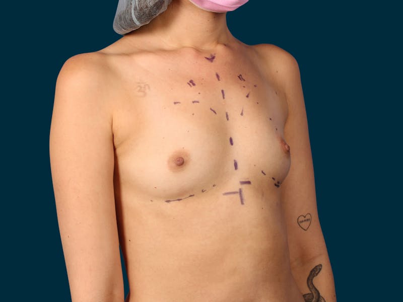 Breast Augmentation Before & After Gallery - Patient 134618 - Image 5