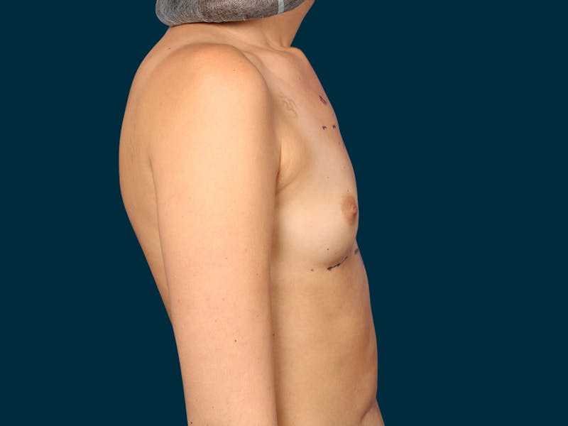 Breast Augmentation Before & After Gallery - Patient 134618 - Image 7